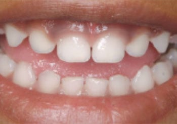 Healthy baby teeth