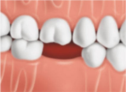 Position of teeth immediately after a tooth is lost