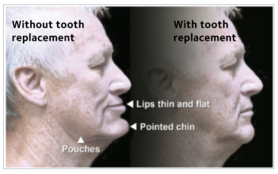 When teeth are lost and not replaced, the face looks older