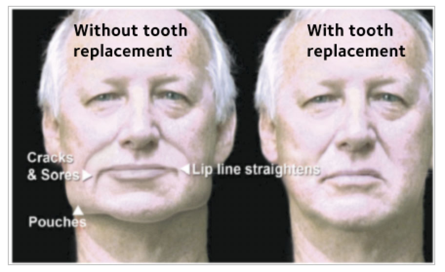 The mouth loses some of its shape, and the lip line straightens
