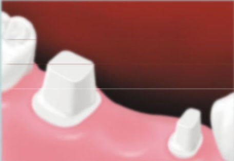To replace a missing tooth with a conventional three-unit bridge, teeth next to the gap are reduced