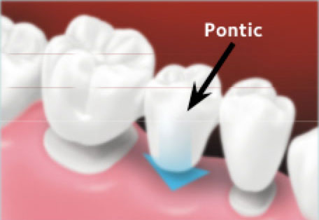 The custom-made bridge is placed over the prepared teeth