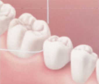 Gently rub the side of each tooth next to the bridge with the floss, cleaning under the gum, too