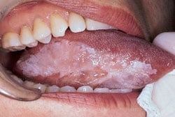 Example of Candidiasis