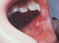 Example of a canker sore