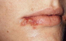 Example of a cold sore