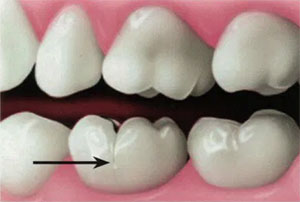 A small crack in the tooth