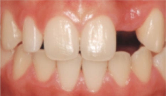 Missing tooth