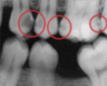 This bitewing shows several areas of decay between (and within) teeth