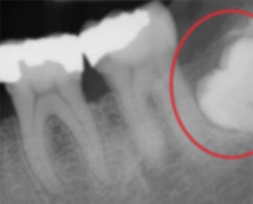 This periapical x-ray shows the top of a molar unable to reach the surface (impacted)