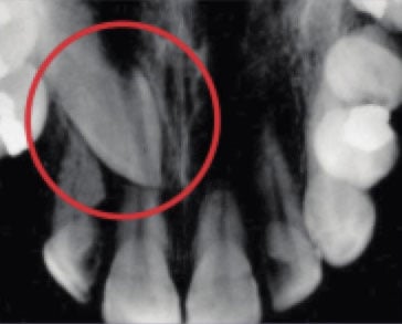 This occlusal x-ray shows a tooth that hasnot yet reached the surface (unerupted)