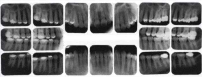Complete series x-ray