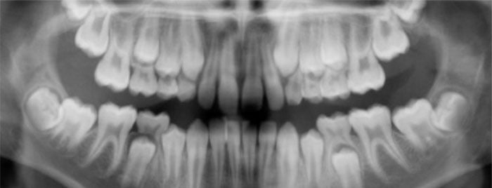 This panoramic x-ray shows baby teeth as well as the developing permanent teeth that have not yet reached the surface