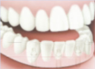 After implants