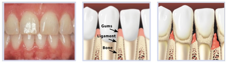 Healthygums and bone hod teeth firmly in place.