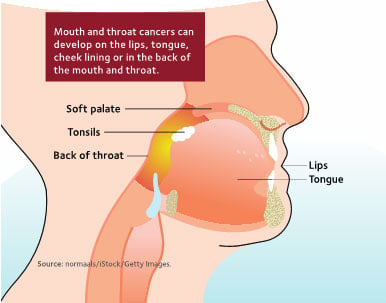 oral cancer infographic