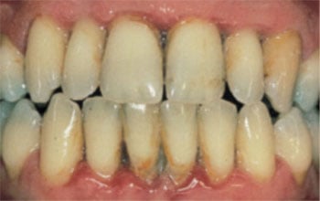 Severe periodontal disease