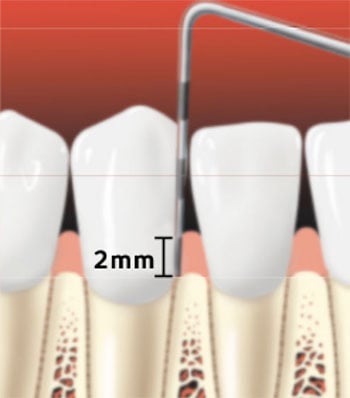 Normal, healthy gums