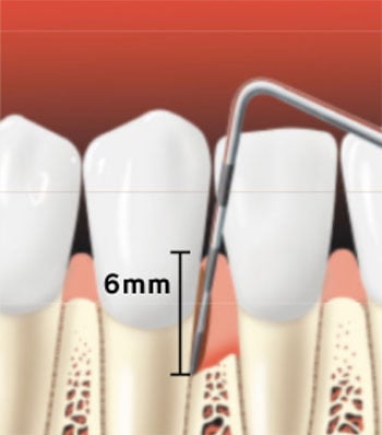 Severe periodontal disease