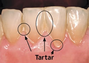 Teeth before professional dental cleaning