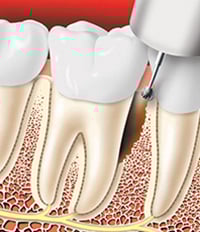 Diseased tissue is removed from the pocket. In some cases, the bone may be reshaped