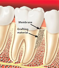 Grafting material is placed over the bone