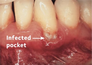 Tooth with infected pocket before treatment
