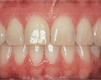 Healthy Gums – No Disease