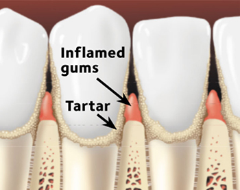 Gums with Gingivitis
