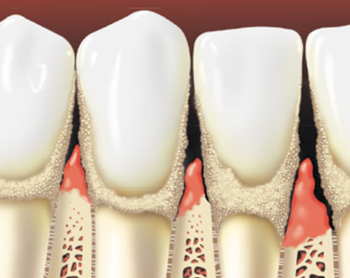 Gums with Periodontitis