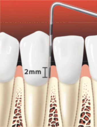Periodontal probe of healthy gums