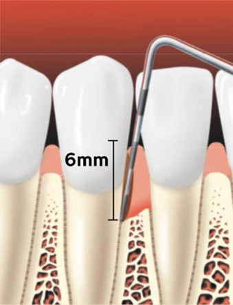 Periodontal probe showing a pocket forming between the tooth root and the gums