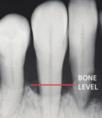 Gum disease can create bone loss
