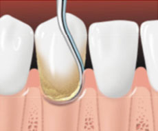 Scaling removes plaque and tartar from below the gumline