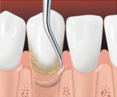 Root planing smothes the tooth root and helps the gums reattach to the tooth
