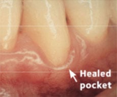 Healed pocket after treatment
