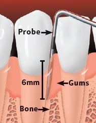 Probe shows pockets due to gum disease. Gums are inflamed and bone loss has occured