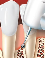 The bone is contoured and any remaining tartar is removed