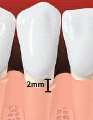 Healed site after periodontal surgery