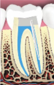 The crown of the tooth is then restored