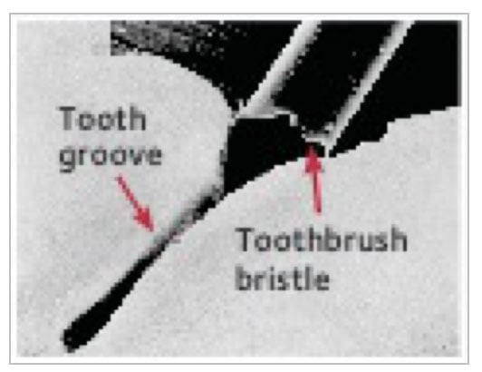Even a toothbrush bristle is too big to reach inside a groove in the tooth