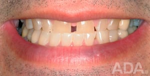 Smile with tooth gap