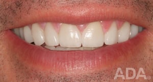 Smile with no tooth gap