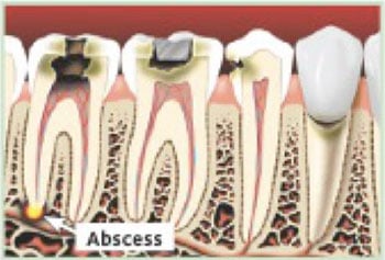 If not treated, tooth decay can cause an abcess and can lead to serious infections