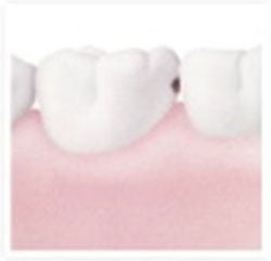 Decay in between teeth