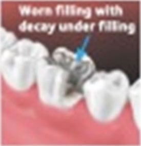 worn filling with decay under filling