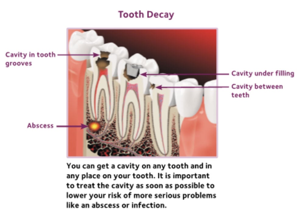 Illustration of tooth decay
