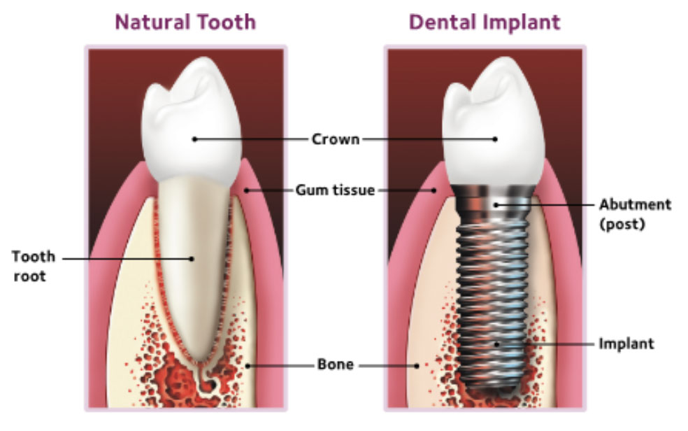 Diagram of the differences between a natural tooth and a dental implant